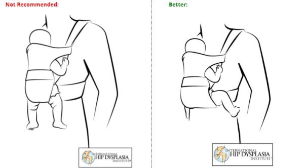 hip dysplasia baby carrier