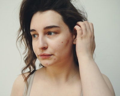 At What Stage Of Pregnancy Do You Get Acne? At What Stage Of Pregnancy Do You Get Acne?