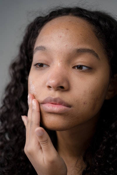 How To Get Rid Of Pregnancy Acne How To Get Rid Of Pregnancy Acne