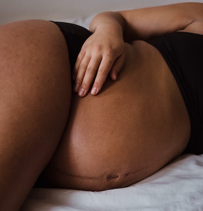 How do you know when stretch marks are forming