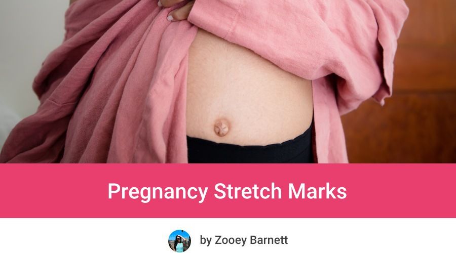 When Do Stretch Marks Appear In Pregnancy + Do Pregnancy Stretch Marks Go Away