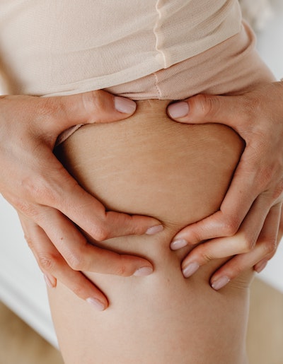 postpartum body changes - stretch marks